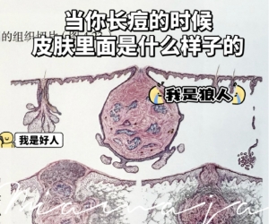 皮肤爆痘留印又留坑的真相
